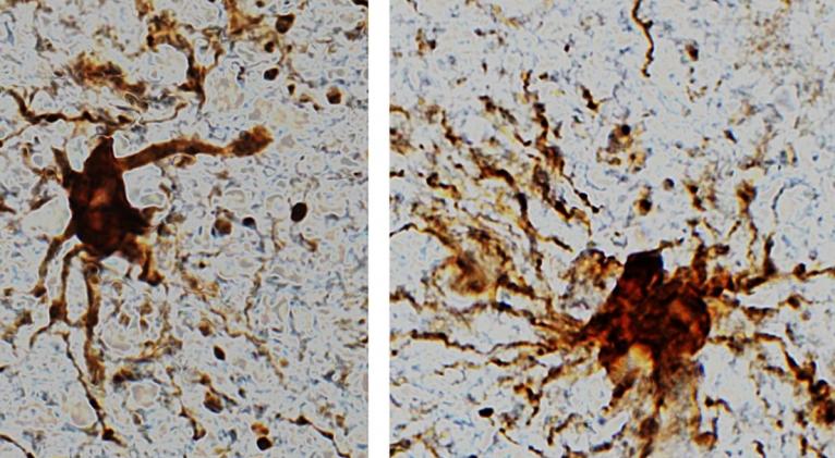 Descubren en el cerebro "células zombis" que continúan creciendo horas después de la muerte